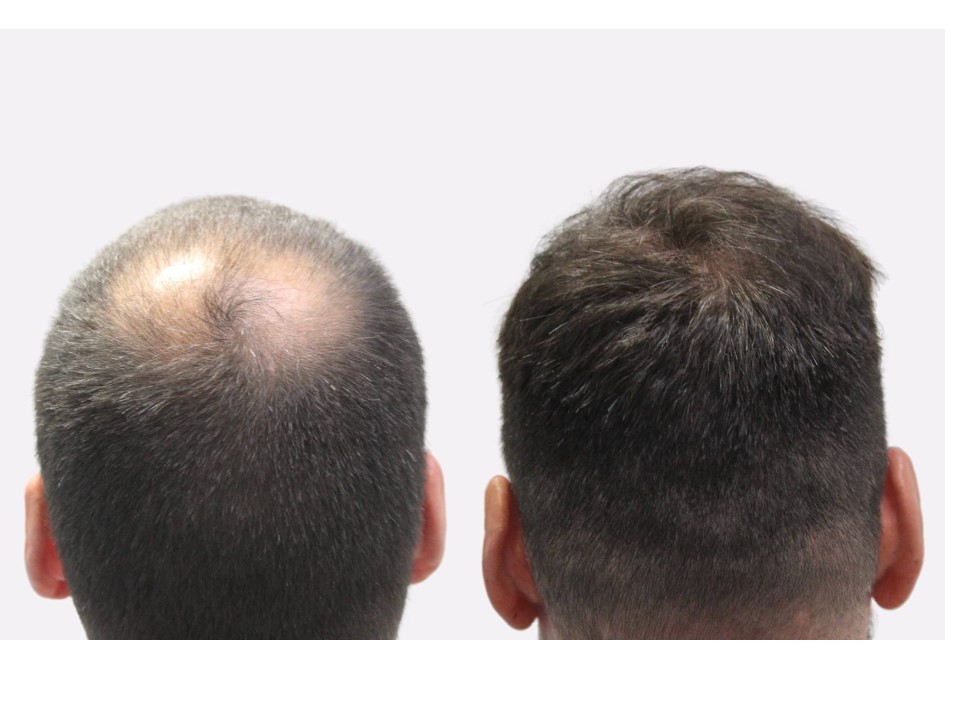 Hair restoration