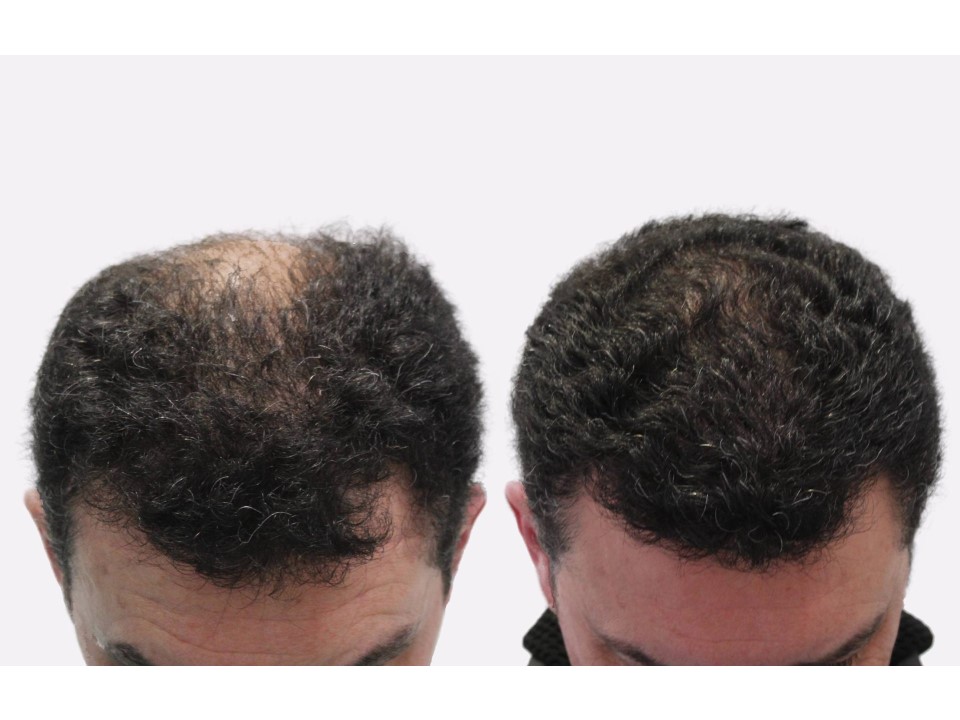 Hair restoration before and after, 4,100 graft case