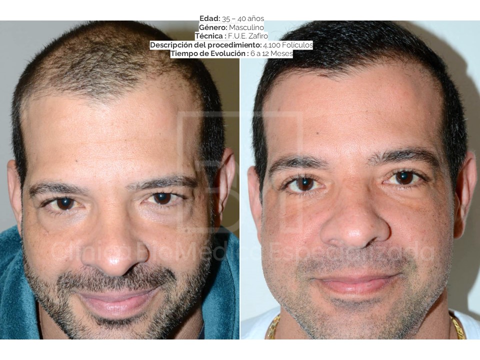 Hair restoration before and after, 1,800 graft case