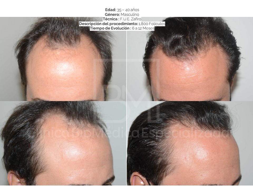 Hair restoration before and after, 2,150 graft case